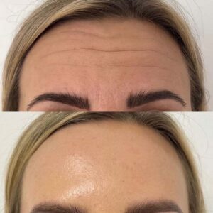 Botulinum Toxin for Miscellaneous therapeutic benefits – Only Peptide