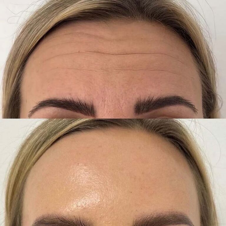 Botulinum Toxin for Miscellaneous therapeutic benefits – Only Peptide