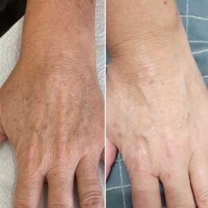 Glutathione Injection Pen for Skin Brightening and Detox