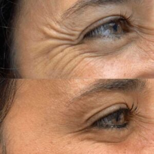 Snap-8 Peptide for Wrinkles by Only Peptide